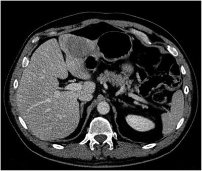 Robotic resection of a single adenoid cystic tumor liver metastasis using ICG fluorescence. A case report and literature review